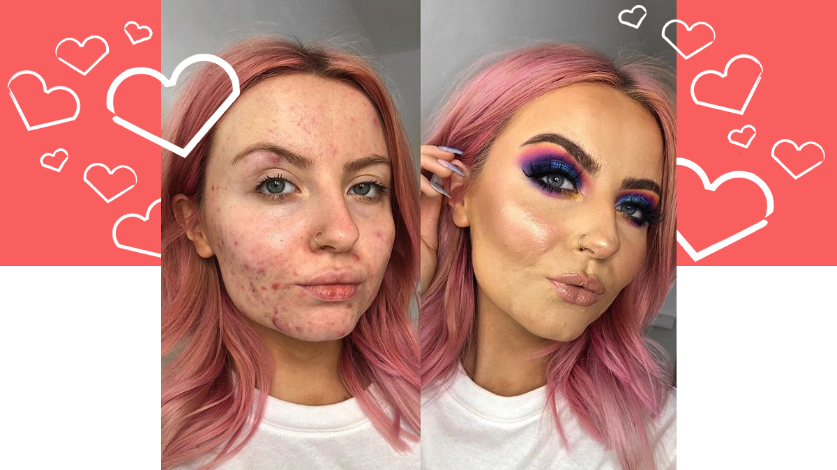 Abbie Bull S Acne Positivity Will Inspire You To Embrace Your Skin Beauty Bay Edited