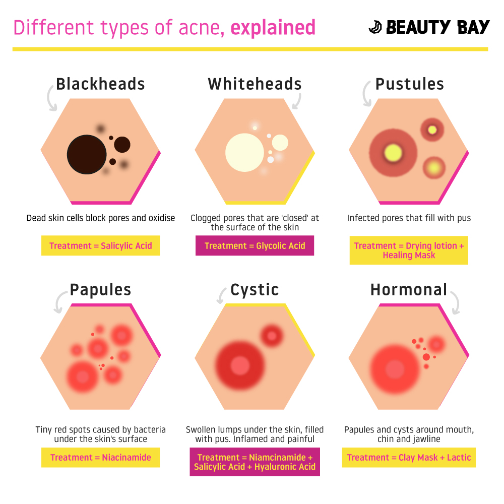 6 Different Types Of Acne Explained Beauty Bay Edited