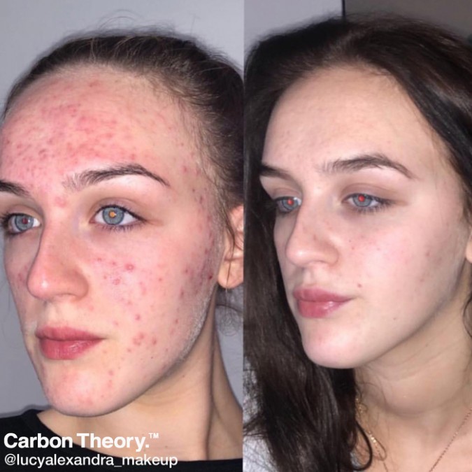 6 Reason's Why You Need To Try Carbon Theory's Acne Soap - Beauty Bay ...