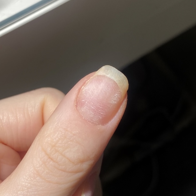 Ridges in Nails: Causes, Treatments and Prevention