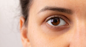 Ask Grace: What’s The Best Way To Conceal Dark Circles?