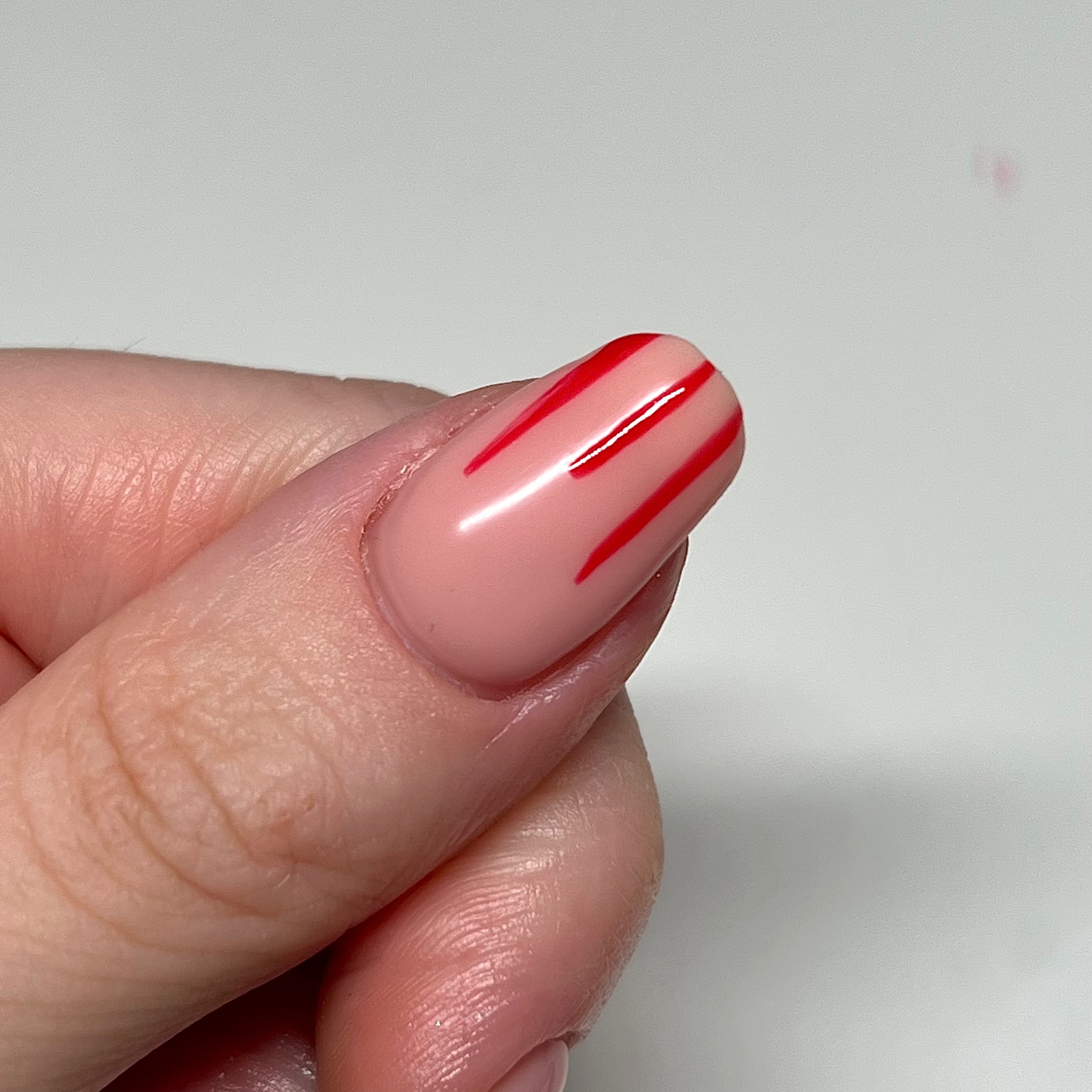 What are Nail Fold Infections (Paronychia)?