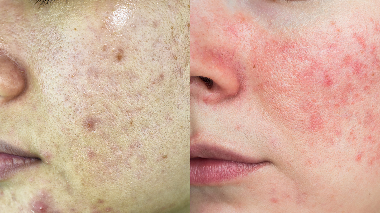 Skin Purging Breakout: How To Tell The Difference, 59% OFF